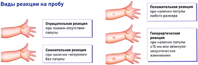 Что такое диаскинтест для детей